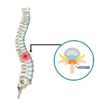 Lumbar spinal stenosis