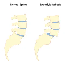Spondylolisthesis